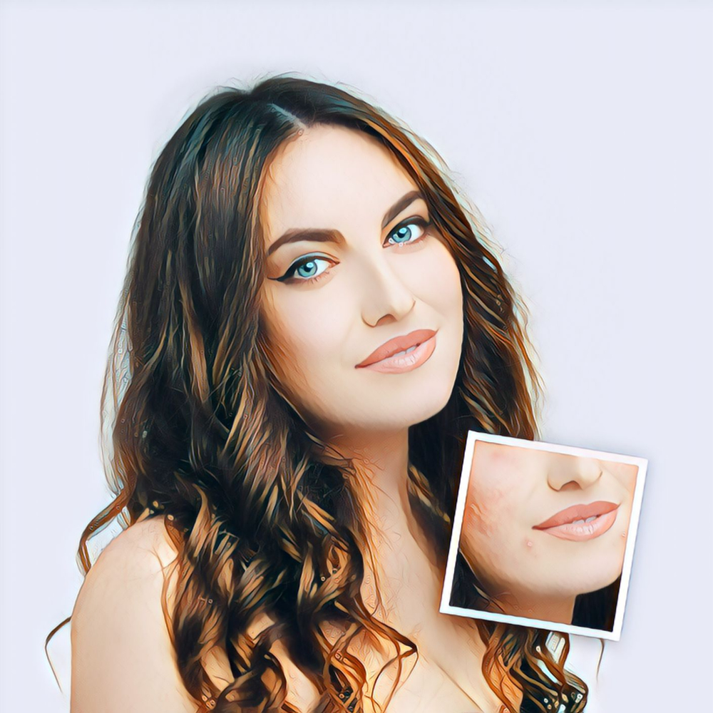 Best Foundation For Acne-Prone Skin That Won't  Clog Pores And Make You Look Flawless