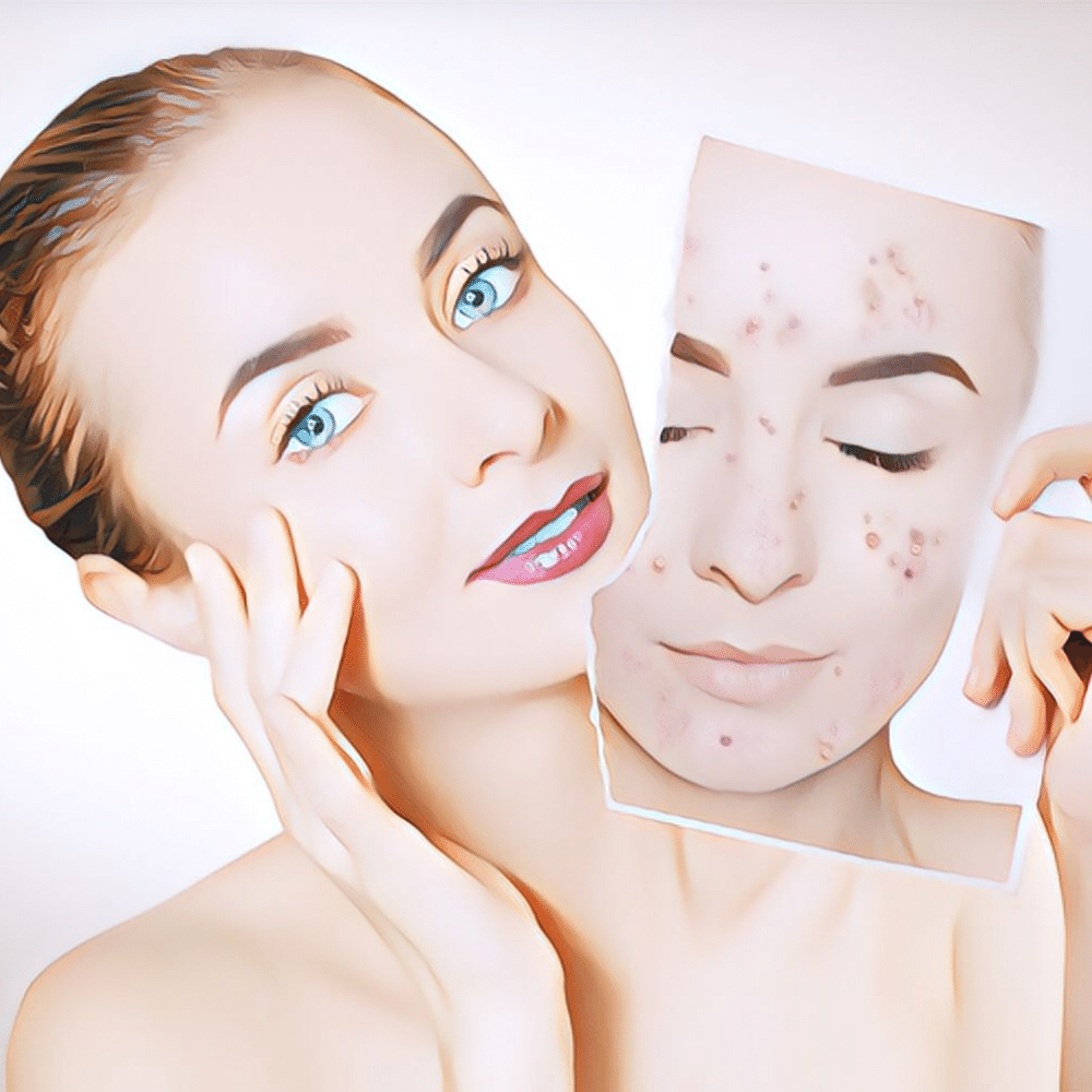 Best Vitamins for Acne: Which Supplements Actually Work?