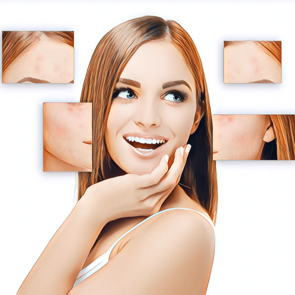 Pimple Party Poopers: 5 Tips for Keeping Your Acne-Prone Skin Under Control