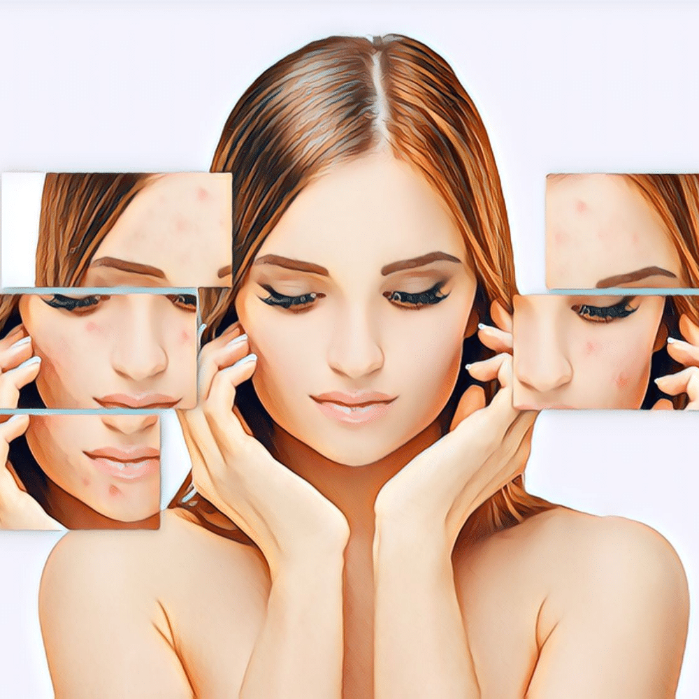 The Best Makeup Tips for Acne-Prone Skin